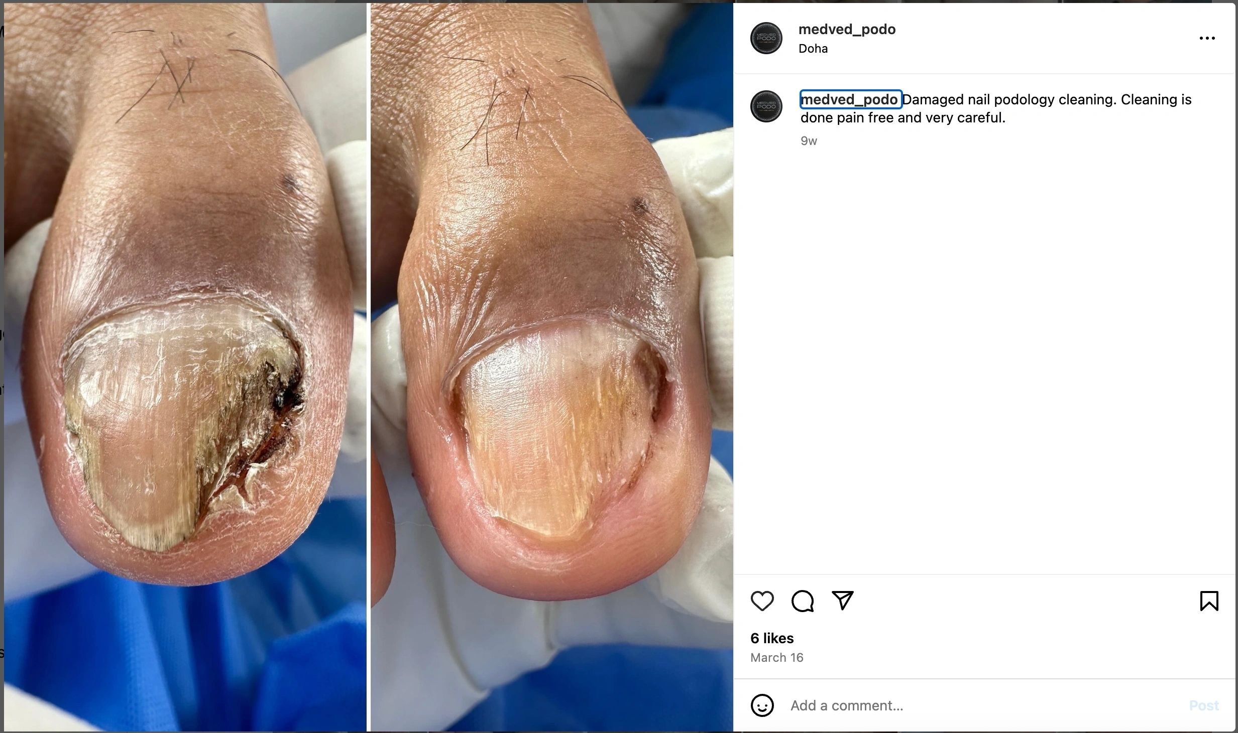 Before and after ingrown nail care