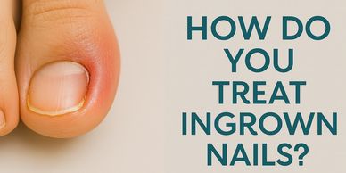 How Do You Treat Ingrown Nails?